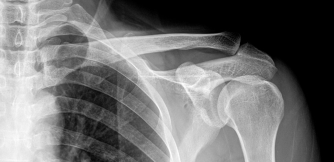 Привычный вывих плеча на рентгенографии