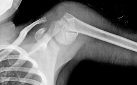 Перелом плеча на рентгеновском снимке