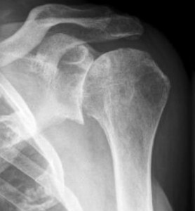 Остеохондроз плечевого сустава на рентгене
