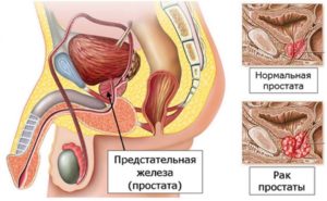  лечение аденокарциномы простаты