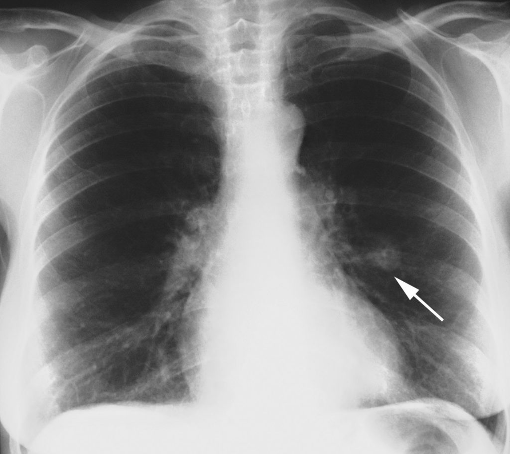 Туберкулома рентген