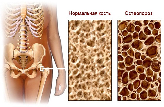 Здоровая и пораженная остеопорозом кость