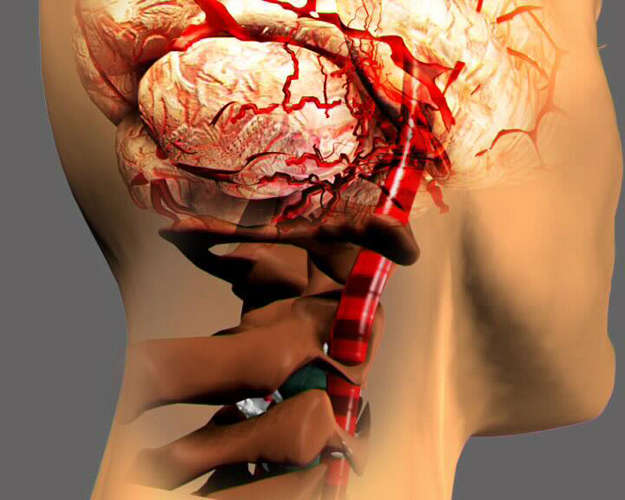 Визуализация синдрома позвоночной артерии