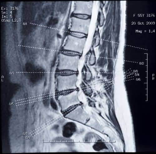 Дорсальная грыжа на снимке МРТ