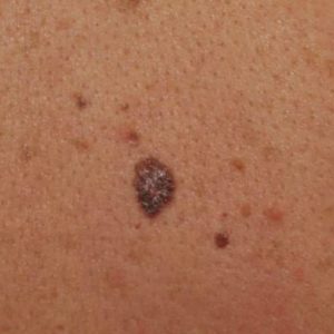Как выглядит меланома кожи на разных стадиях