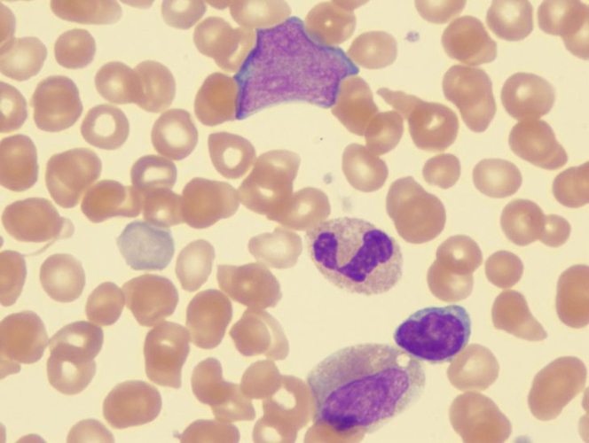 Характерные изменения при миелофиброзе по данным микроскопического обследования крови