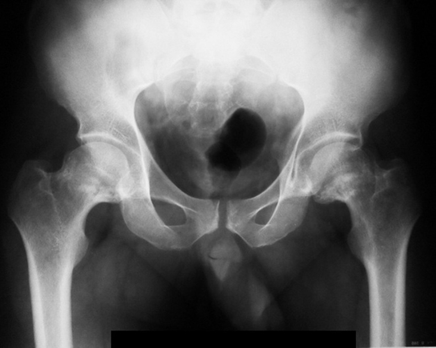 Артроз тазобедренных суставов на рентгеновском снимке