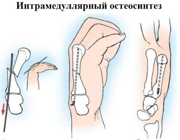 Интрамедуллярный остеосинтез часто проводится на костях верхних конечностей
