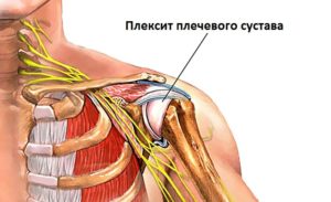 Симптомы и лечение невралгии плечевого нерва