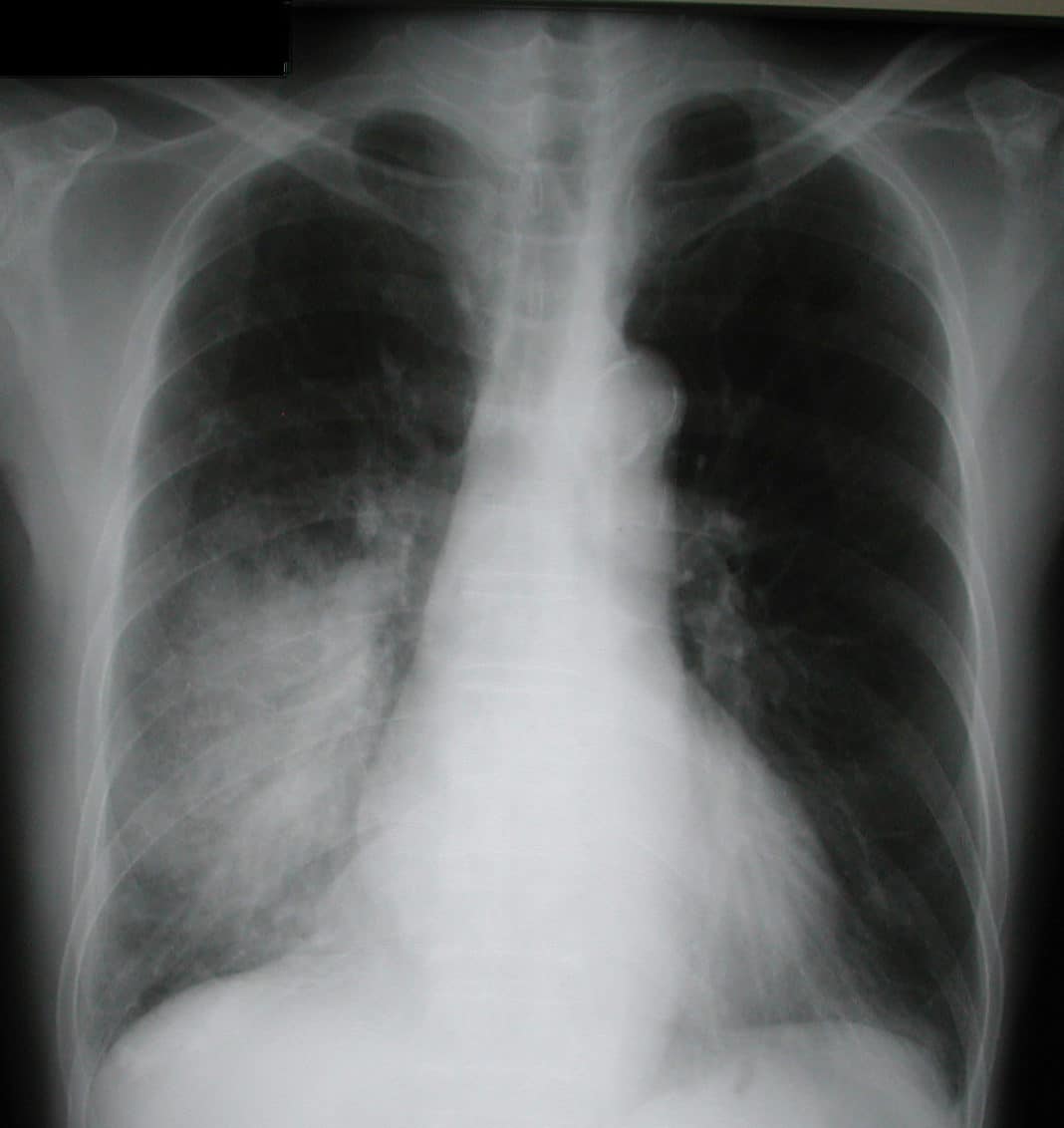 Рентген пневмонии у ребёнка