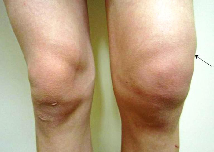 На поздних стадиях артрита возможны сильнейшие отеки (больное колено может стать в несколько больше, чем здоровое)