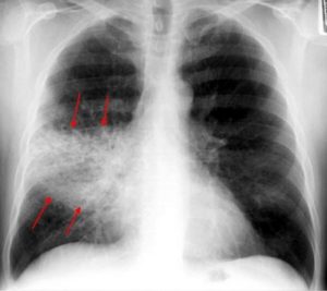 рентгенограмма при крупозной пневмонии