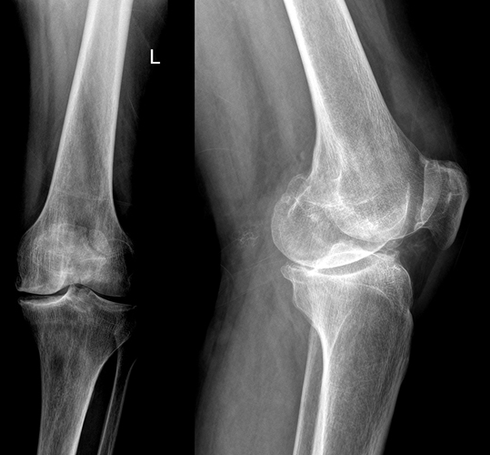 Артроз коленных суставов на рентгенографическом снимке