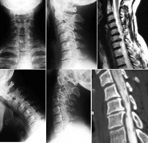 Корешковый синдром на фоне остеохондроза по снимку МРТ