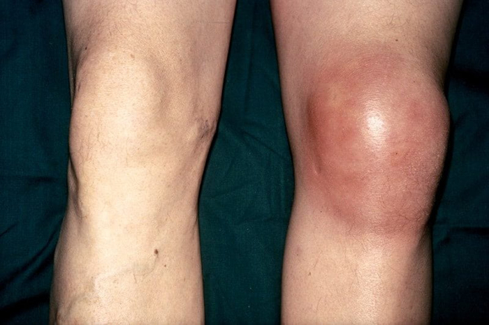 Артрит коленного сустава лечение прогноз thumbnail