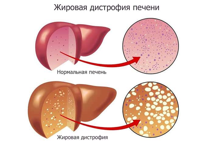 Жировой гепатоз