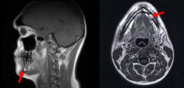 Новообразование на МРТ снимке головы (с прицелом на челюстную область)