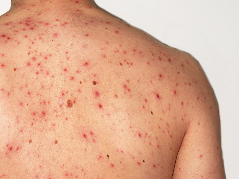 Проявления на коже при гепатите