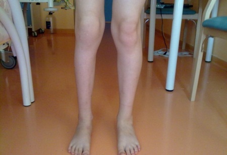Артроз коленного сустава у ребенка