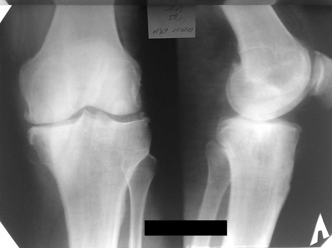 Визуализация локтевого сустава на рентгене