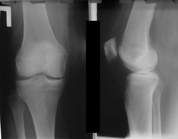 Артроз коленного сустава на рентгеновском снимке фото