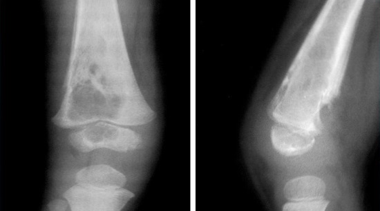 Рентген-визуализация остеомиелита