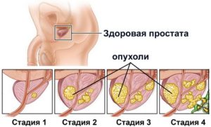 Как лечится доброкачественная гиперплазия предстательной железы