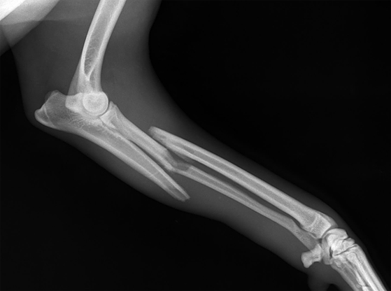 Перелом лучевой кости на рентгеновском снимке