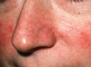 Каковы способы лечение базалиомы кожи носа