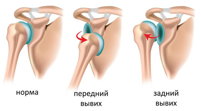 На рентгене плеч можно обнаружить вывих сустава
