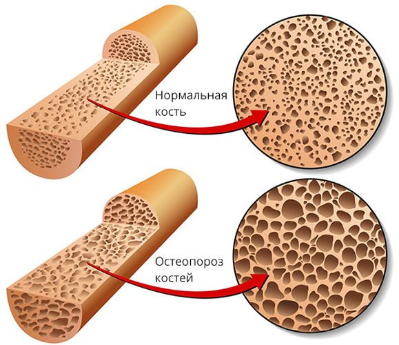 Нормальная и пораженная остеопорозом кость