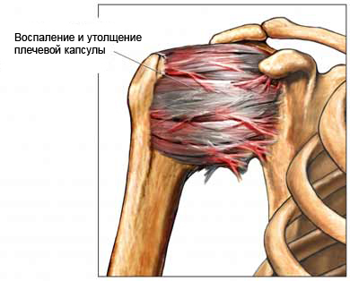 Воспаление и утолщение плечевой капсулы при остеопорозе