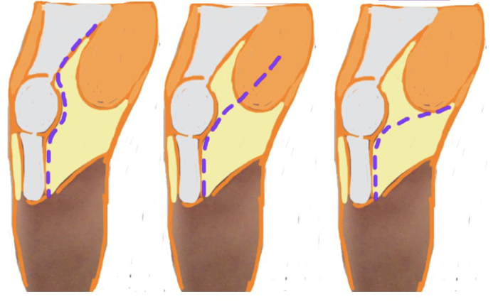 Схема проведения артротомии коленного сустава