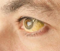 Желтые склеры глаз