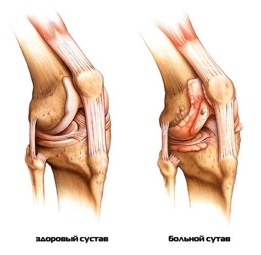 При ревматоидном артрите наблюдается разрушение не только суставов, но и окружающих их тканей