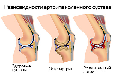 Разновидности артрита коленного сустава