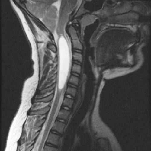 Шейная гидромиелия на МРТ снимке