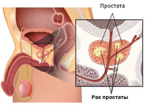  лечение аденокарциномы простаты