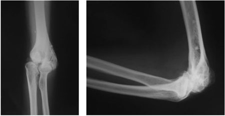 Результаты рентгенографии при артрозе локтя (видны дегенеративные и дистрофические изменения)
