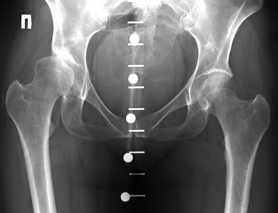 Занимаясь ЛФК нужно регулярно проходить рентгенографию для контроля за состоянием сустава (ЛФК в отдельных случаях может только ухудшить состояние)