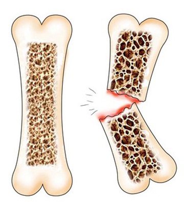 Остеопороз приводит к ломкости костей
