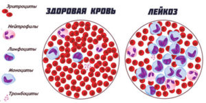 больные при остром лейкозе крови