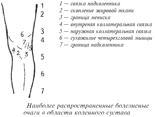 Болезненные очаги в коленном суставе