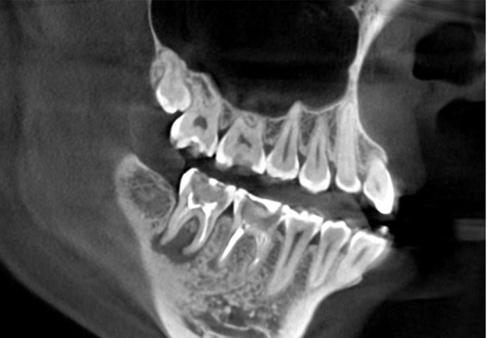 Прицельная магнитно-резонансная томография челюсти
