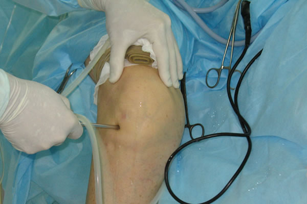 Артроскопическое исследование колена