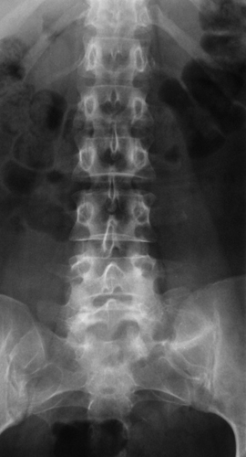 Остеохондроз позвоночника на рентгеновском снимке