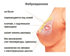 фибромиомы молочной железы