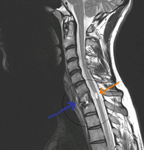 Тяжелый ушиб спинного мозга на МРТ снимке
