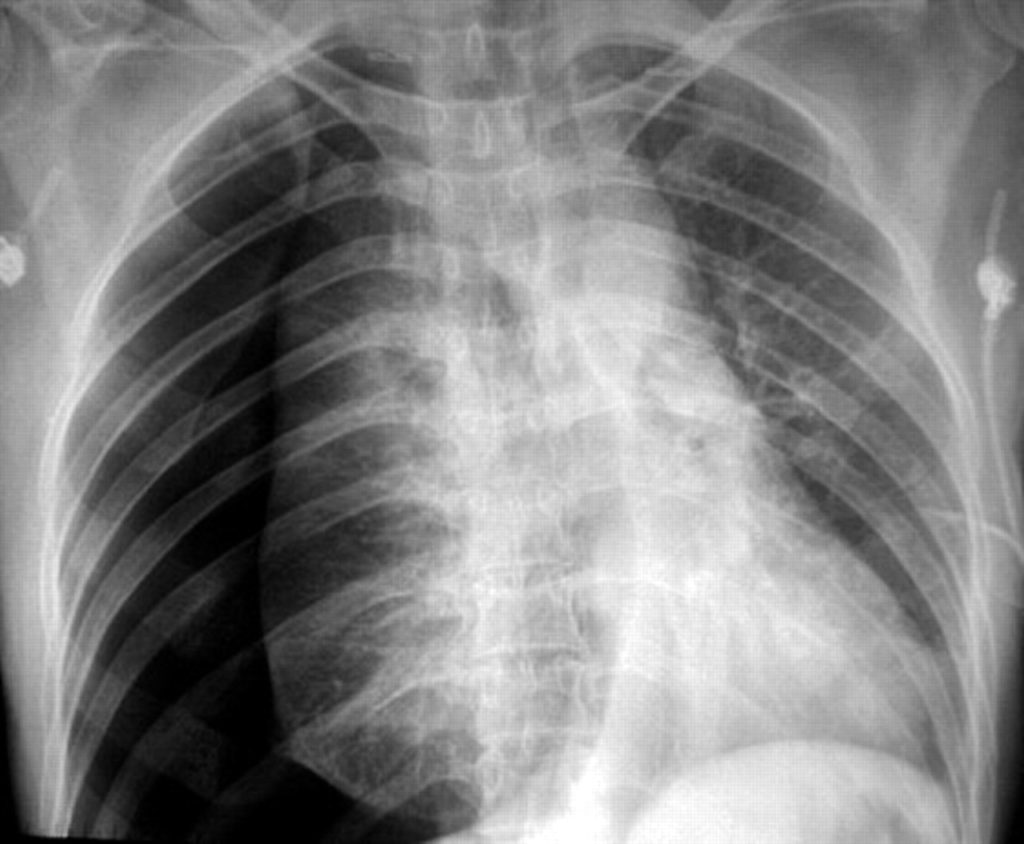 Пневмоторакс лёгкого на рентгене