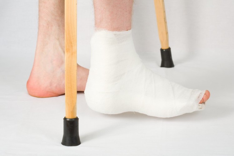 Перелом стопы ступни: симптомы, признаки, сколько ходить в гипсе